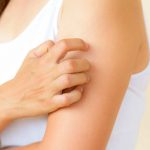 How to Get Rid of Hives 14 Natural Remedies for Hives