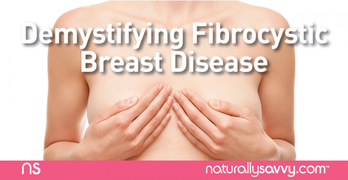 Demystifying Fibrocystic Breast Disease 