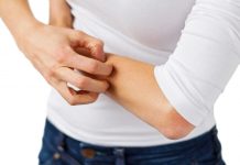Natural Treatments for Hives Skin rash