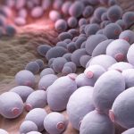 The Awful, Ugly Symptoms of a Candida Infection and How to Cure It Gone The Awful, Ugly Symptoms of a Candida Infection and How to Cure It Gone