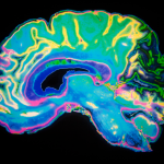 Flashing Lights, Pink Noise and Alzheimer’s Disease Flashing Lights, Pink Noise and Alzheimer’s Disease