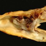 5 Steps To Prevent Atherosclerosis 5 Steps To Prevent Atherosclerosis