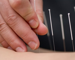 Give Acupuncture a Chance 