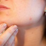 Try These 6 Herbs to Clear Your Acne Acne