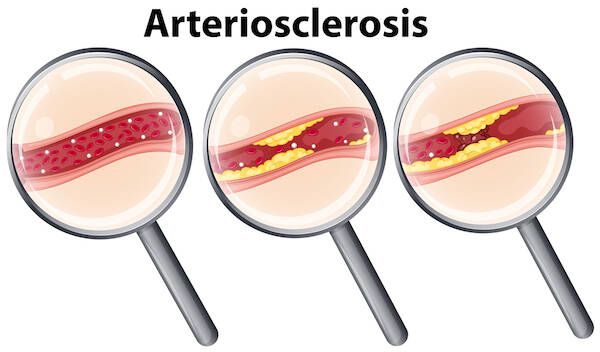 atherosclerosis aged garlic extract